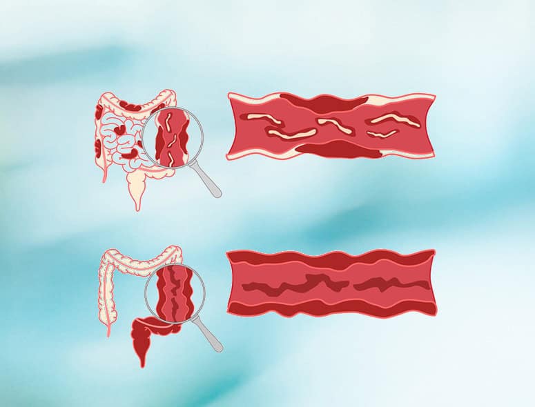 Illustration of ulcerative colitis affecting the colon with magnified view.