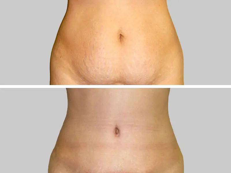Before & After 4