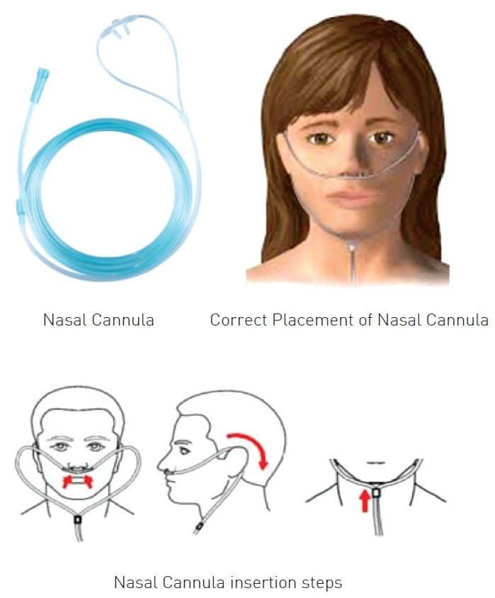 Nasal Prong, Nasal cannula