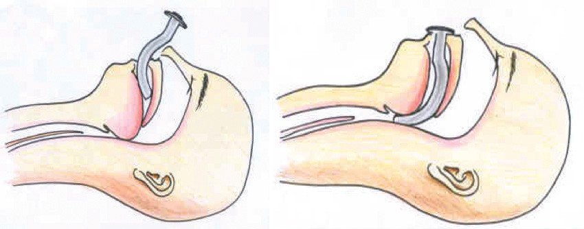 placement of oropharyngeal airway