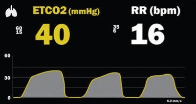 waveform capnography normal range