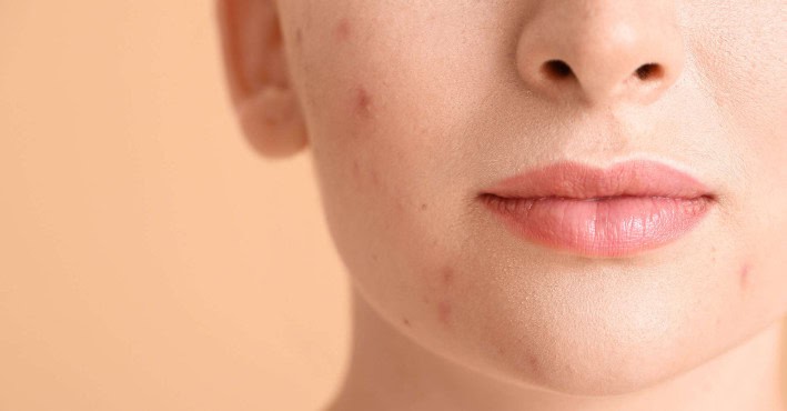 Tratamiento del acné con CBD