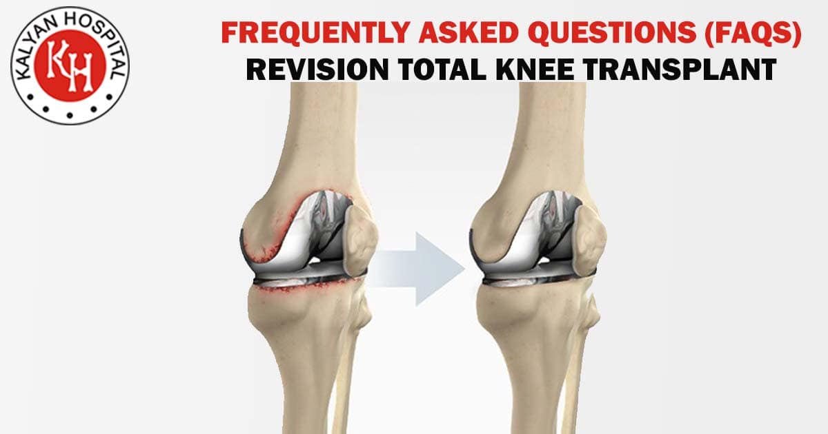 Frequently Asked Questions (FAQS) - Revision Total Knee Transplant