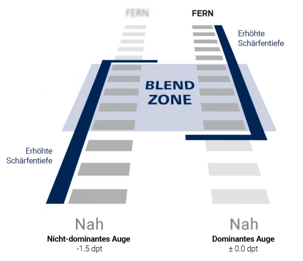 Presbyond Blend Zone