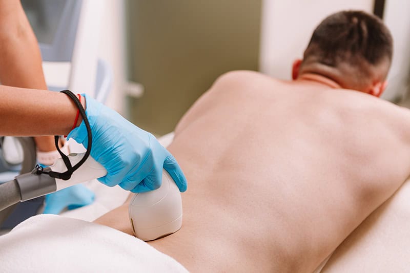Pilonidal Abscess laser hair removal treatment
