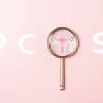 PCOS Laser hair removal