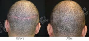 Scalp Micropigmentation for Scars