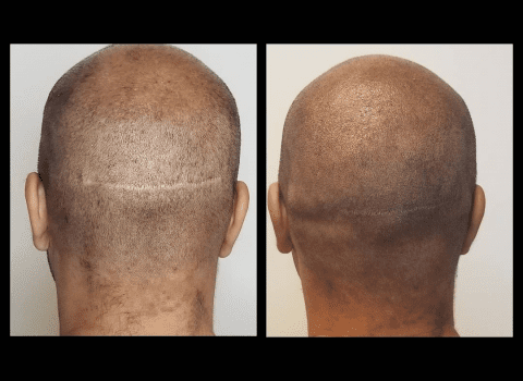 Scalp Scar Camouflage Atlanta