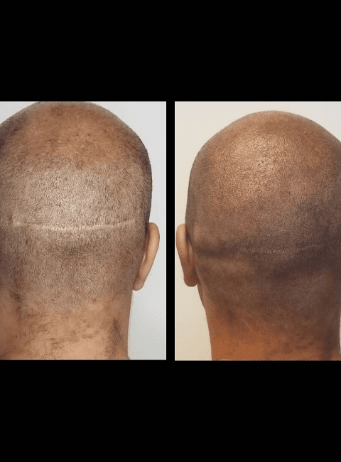 Scalp Scar Camouflage Atlanta