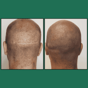 Before-and-after back views: left shows thinning crown, right shows fuller hair coverage after treatment.