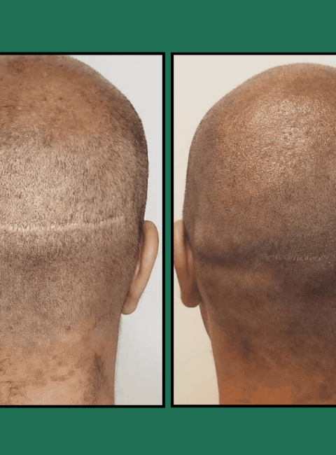 Before-and-after back views: left shows thinning crown, right shows fuller hair coverage after treatment.