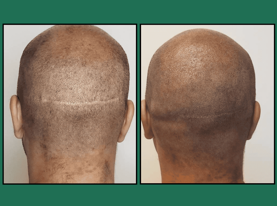 Before-and-after back views: left shows thinning crown, right shows fuller hair coverage after treatment.
