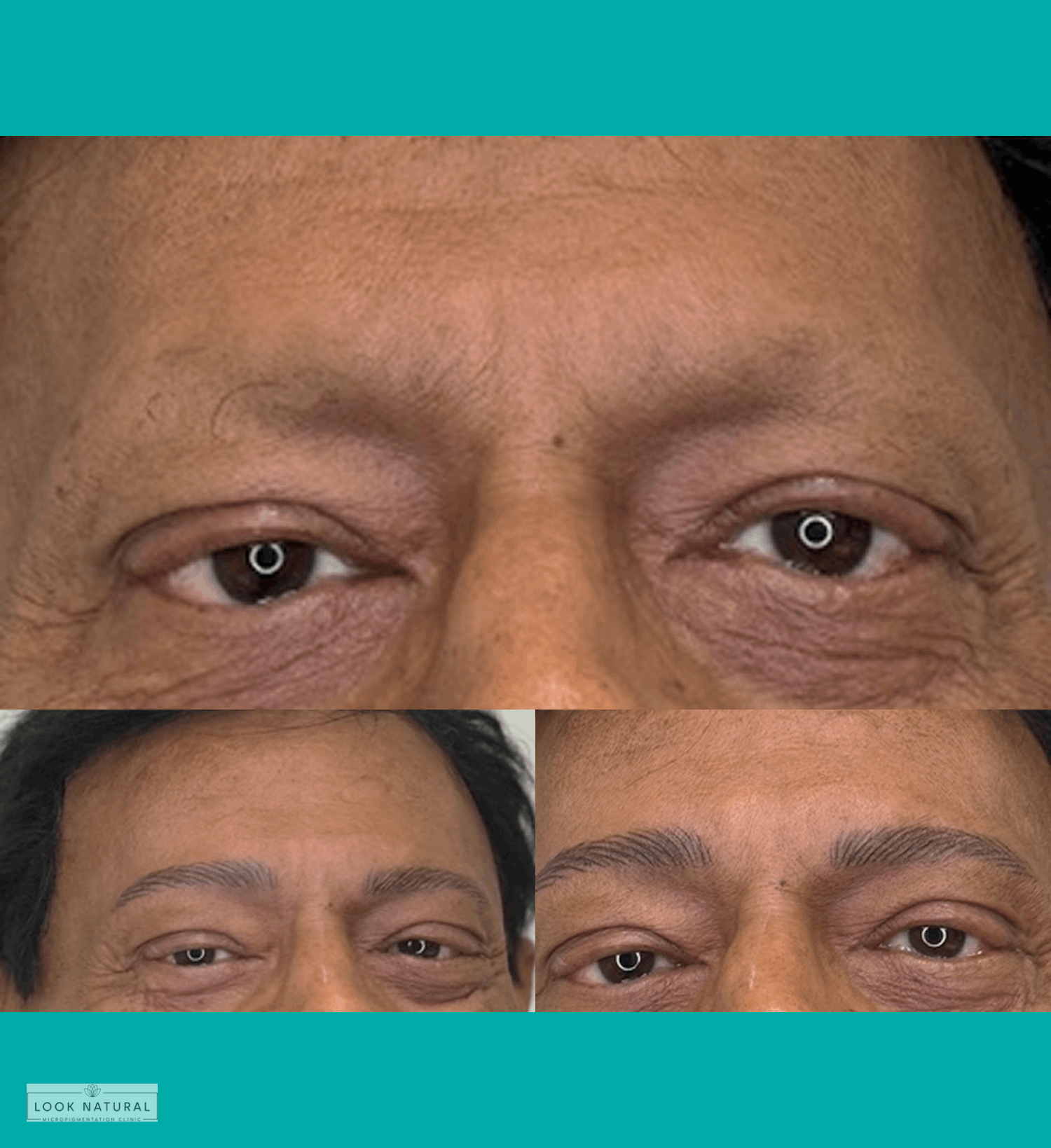 Before and after men’s eyebrow restoration showing natural, fuller brows.
