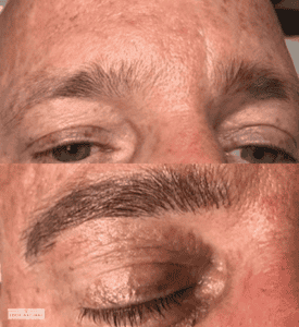 Before and after men’s eyebrow restoration showing transformation from sparse to full brows.