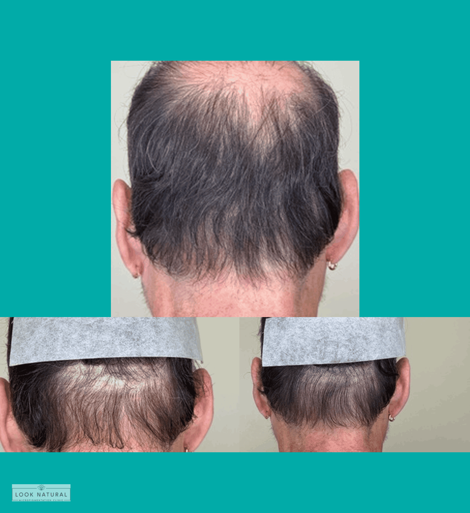 Before and after scalp micropigmentation treatment for bald spot coverage
