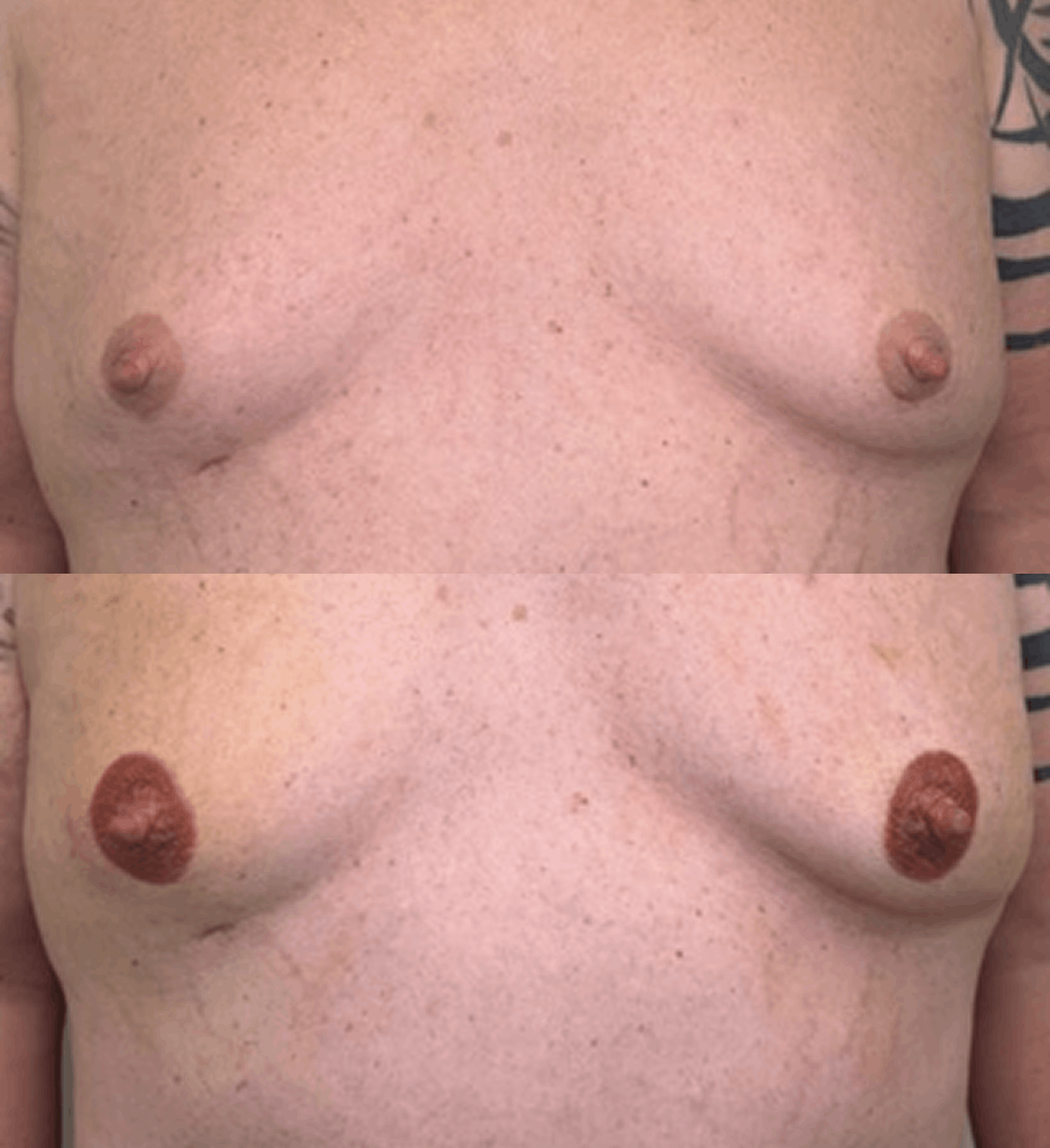 Before and after 3D nipple and areola tattooing for breast reconstruction