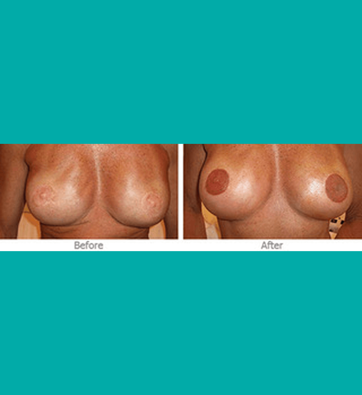 Before and after 3D nipple areola tattooing for breast reconstruction