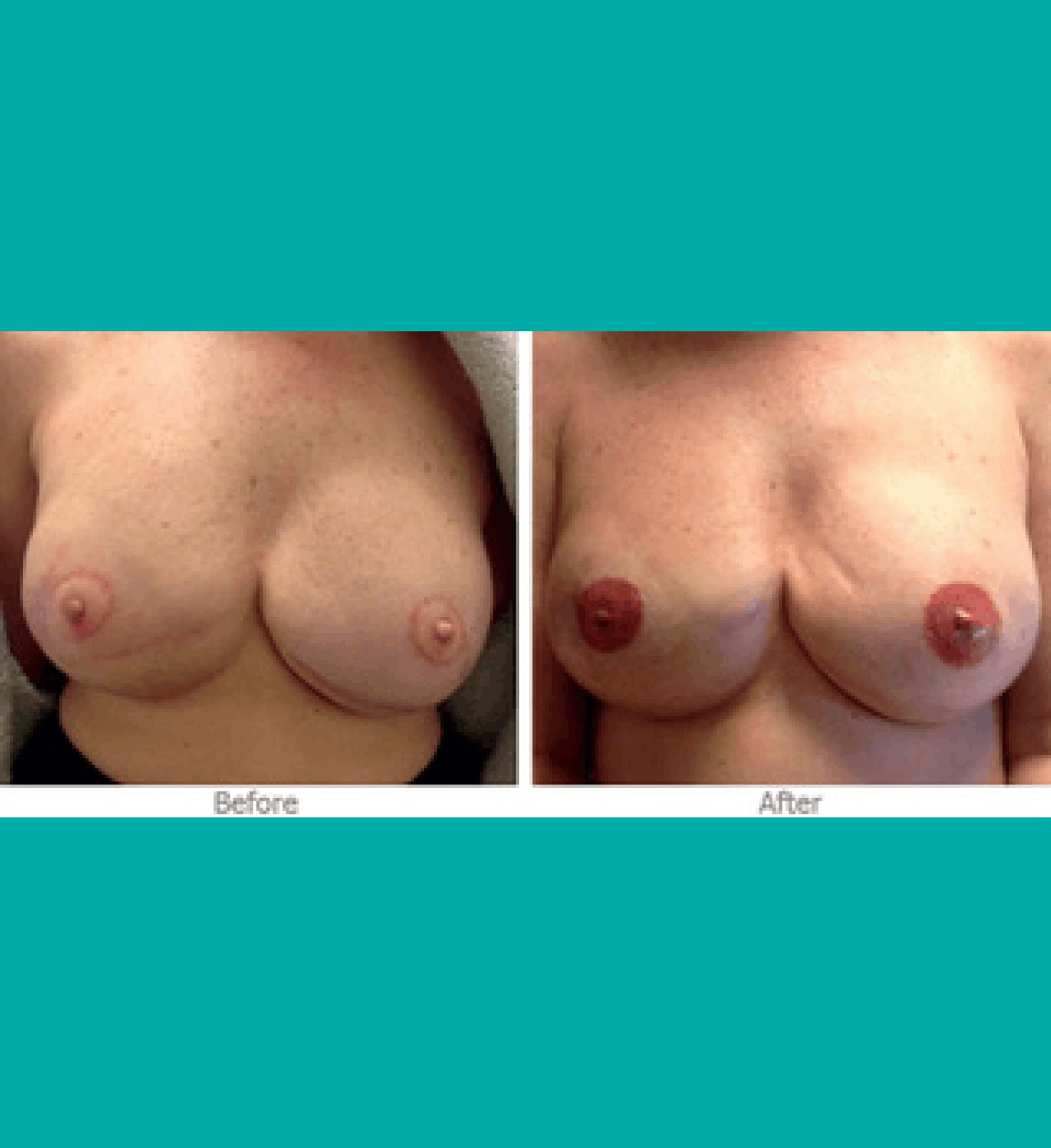 Before and after 3D nipple areola tattooing showing enhanced pigmentation and natural-looking breast reconstruction