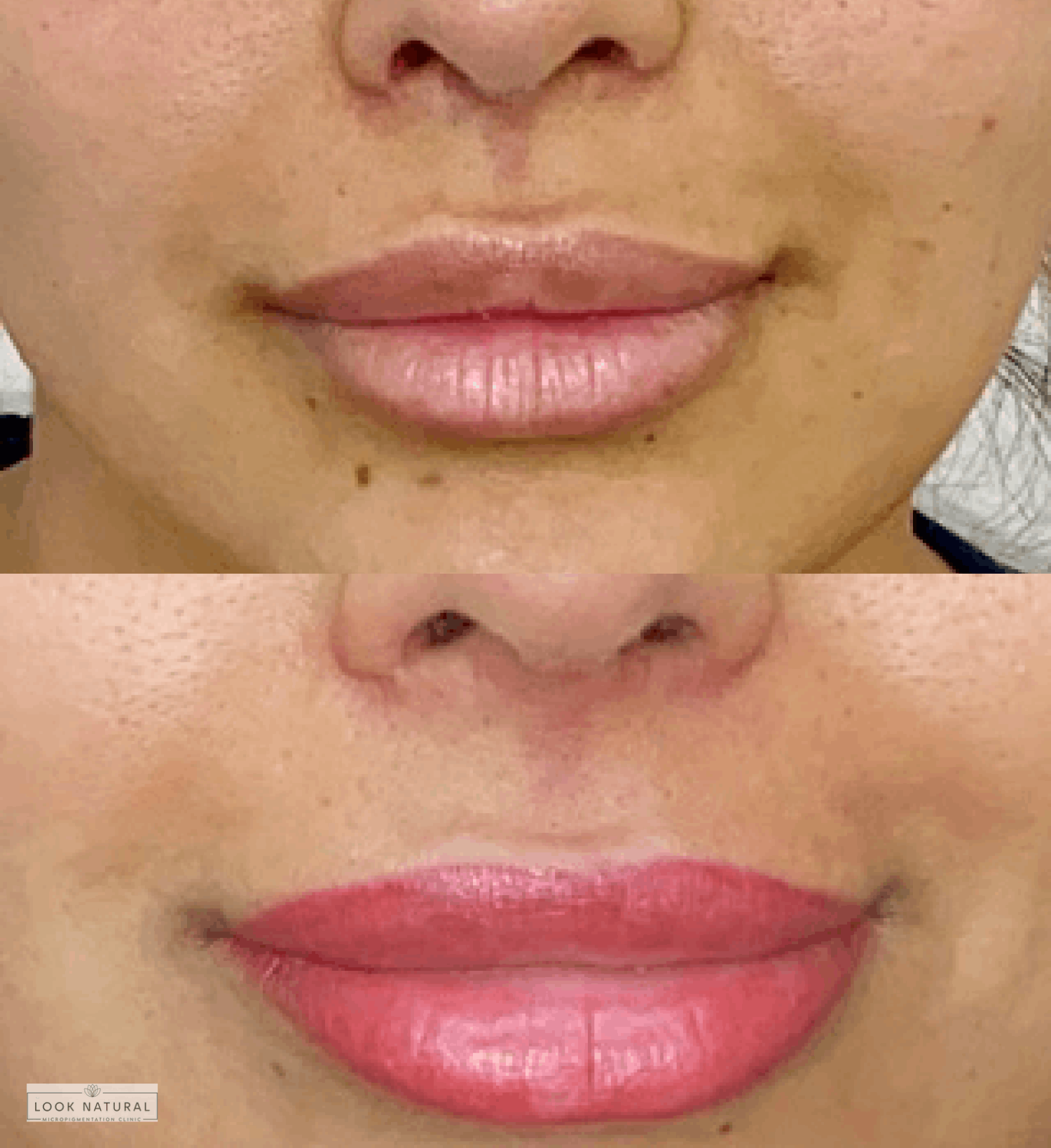 Before and after lip lightening and blush treatment showing vibrant pink lips