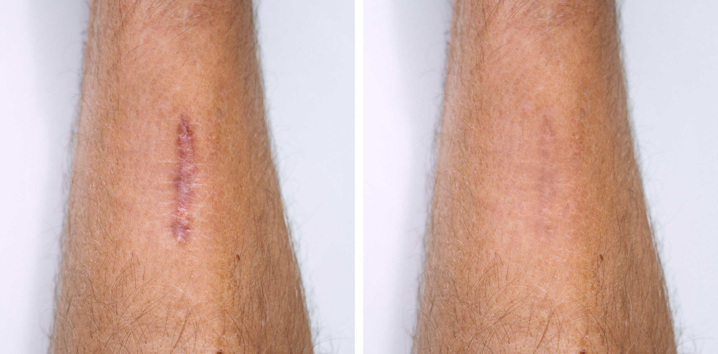 Arm scar before and after camouflage tattooing