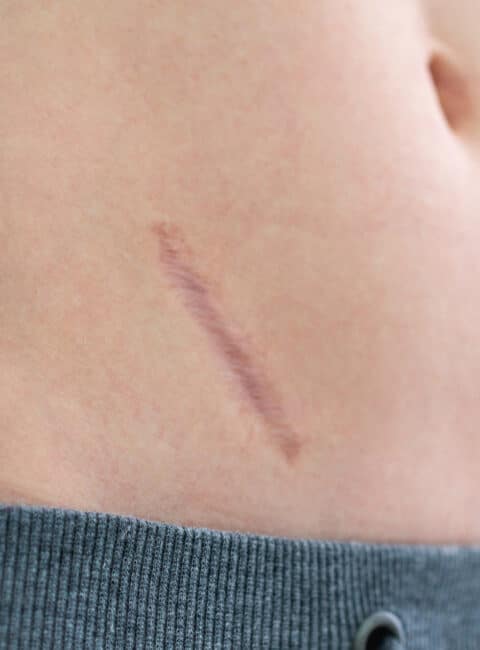 Diagonal scar on the lower back, skin tone with a gray hoodie edge at the bottom edge of frame