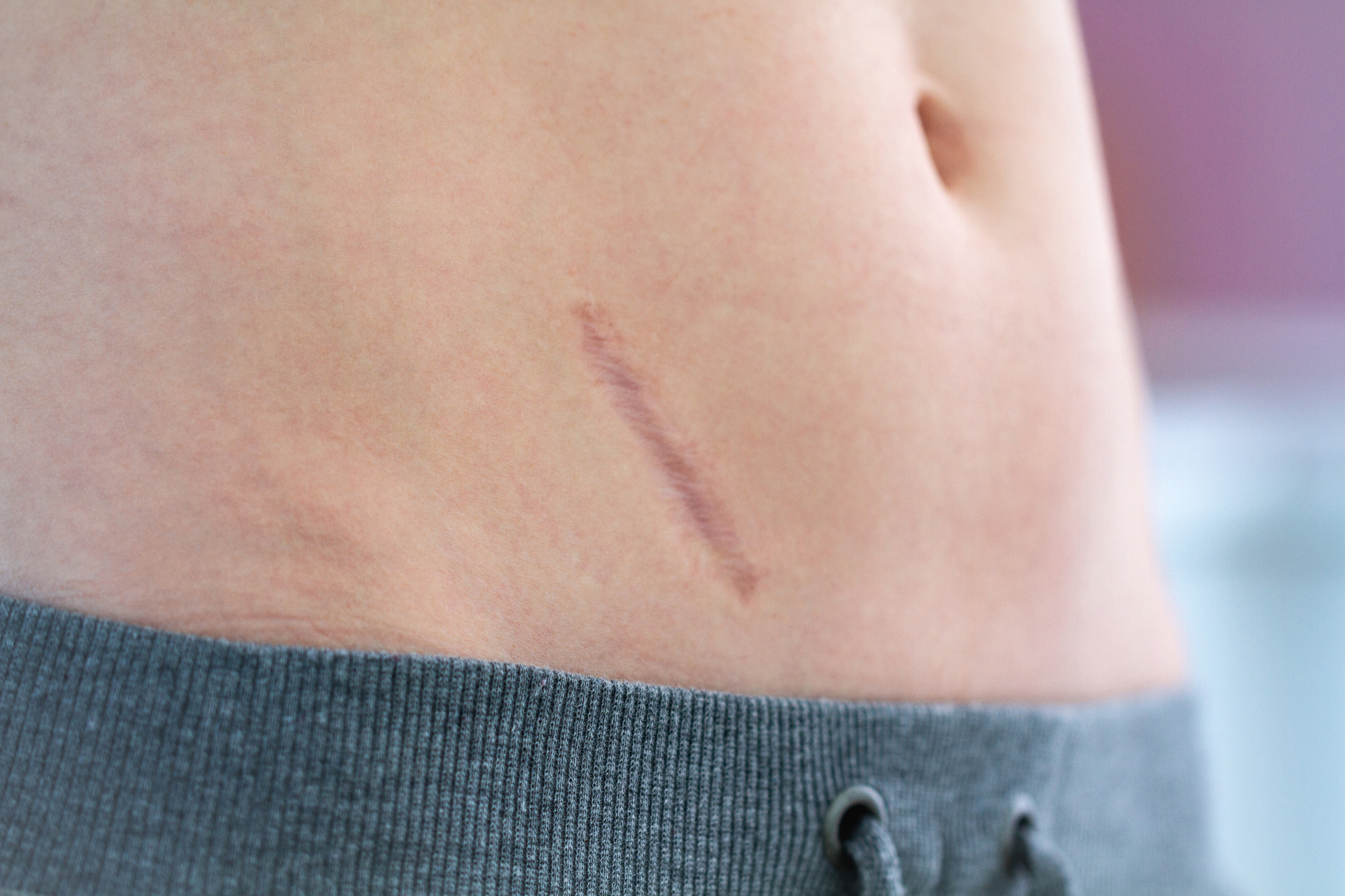 Appendix scar camouflage candidate