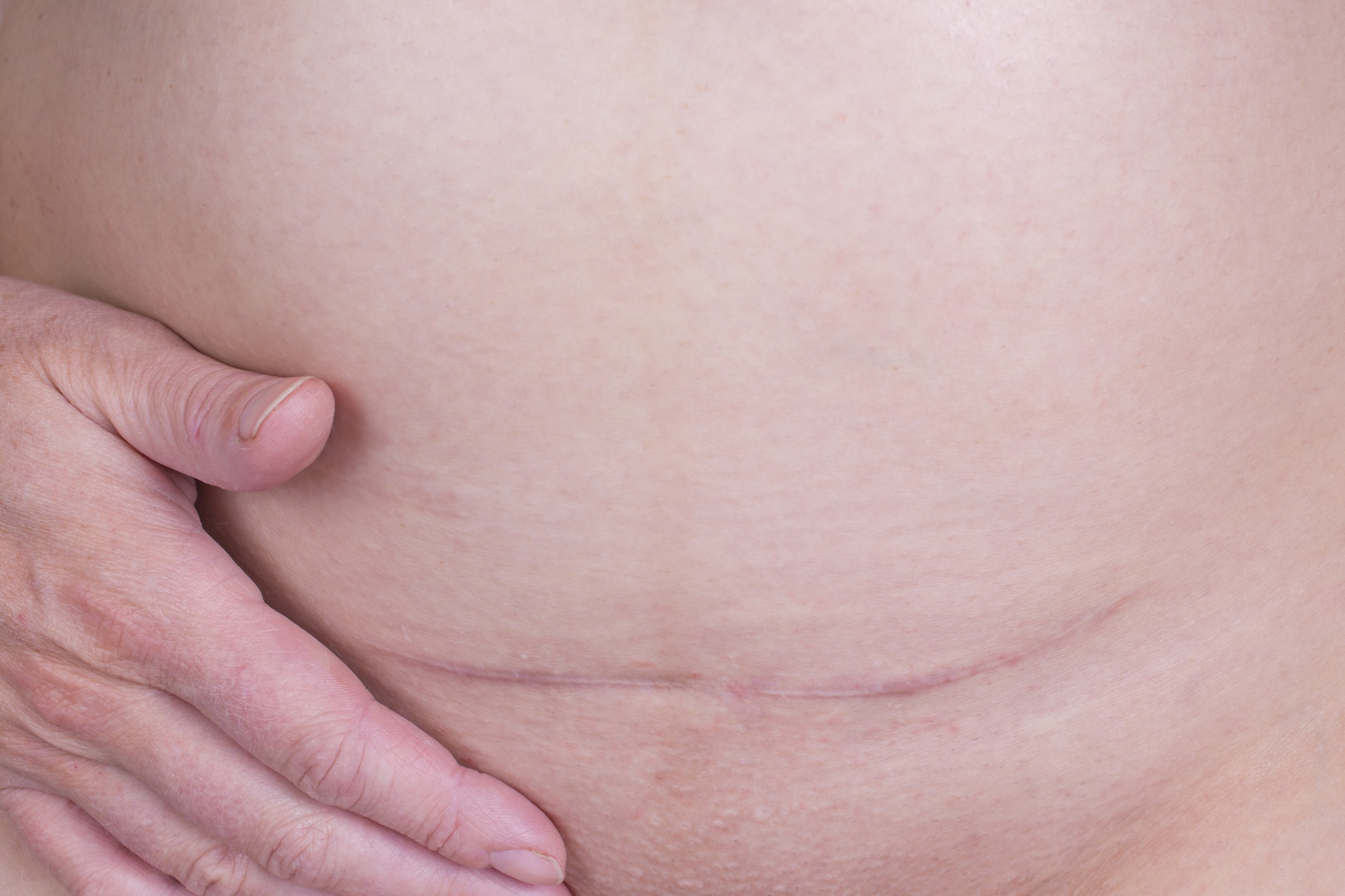 Before and after scar camouflage tattooing