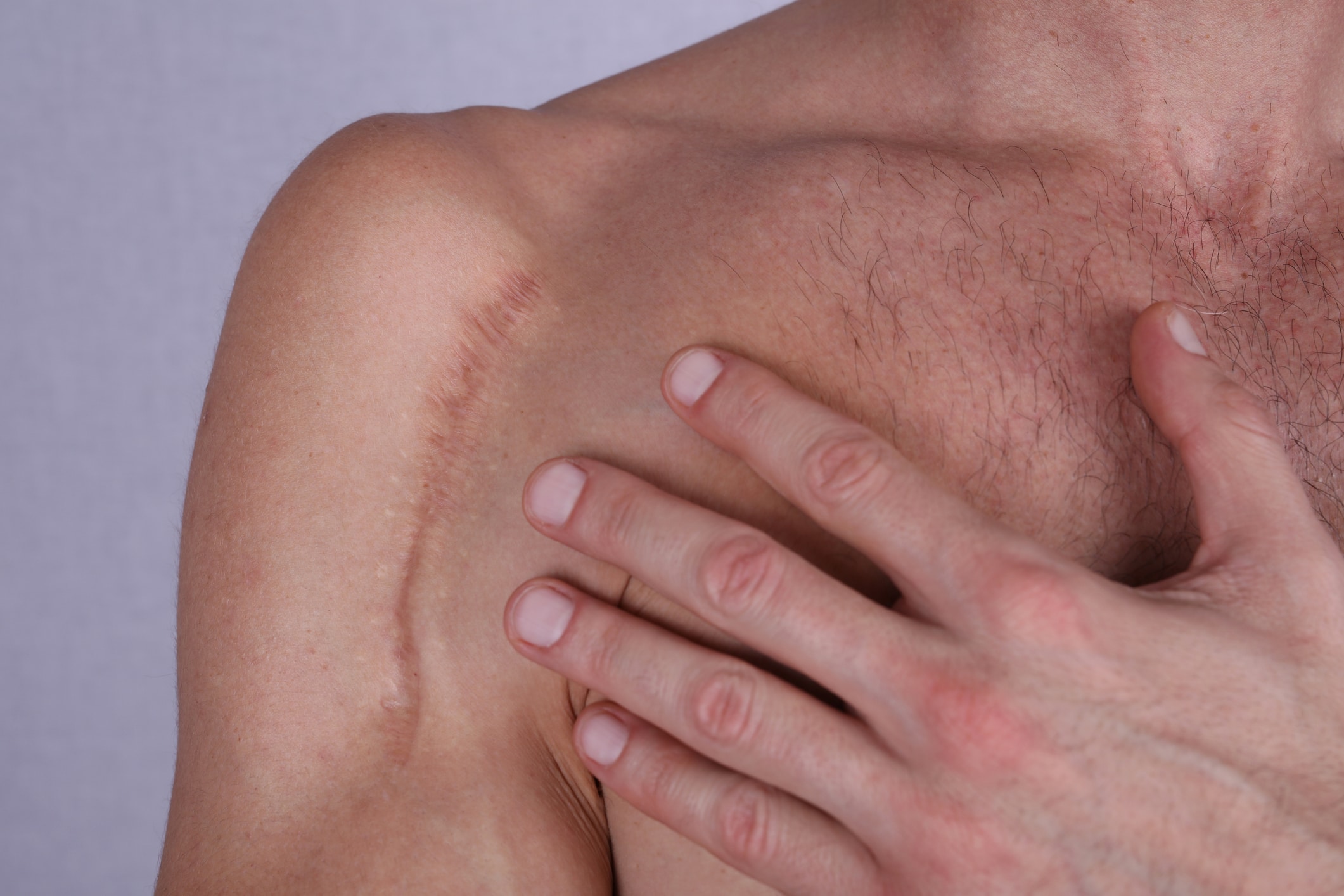 Lighten dark and red scars with scar camouflage tattooing