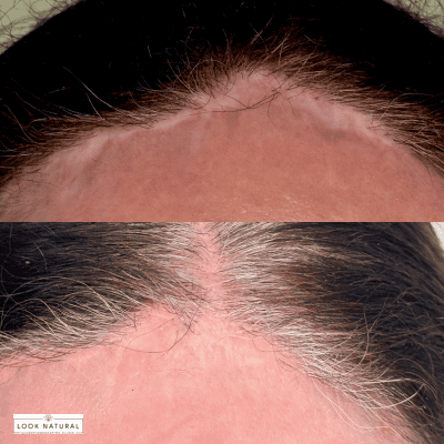 Before-and-after close-up of a hairline restoration on the scalp, showing a scarred, receding line above and a fuller hairline below.