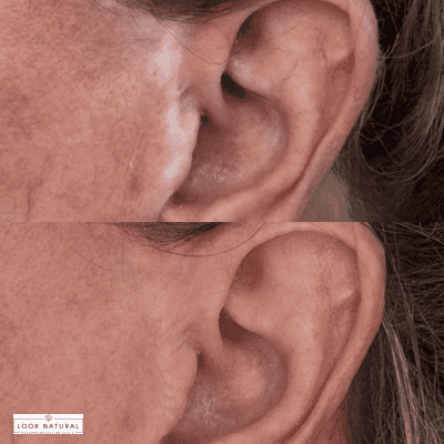 Two close-up shots of a person's ear showing red, irritated skin along the outer ear (before/after comparison).