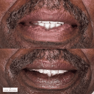 Before-and-after close-up of a man's smile showing whitening results; top image shows darker teeth, bottom image shows whiter teeth (Look Natural logo).
