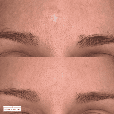 Before-and-after close-up of a forehead and eyebrows, showing reduced pore visibility and smoother skin texture in the second image.