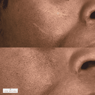 Close-up of a cheek in a before-and-after collage: top image shows textured acne scars, bottom image shows smoother skin with reduced pores.