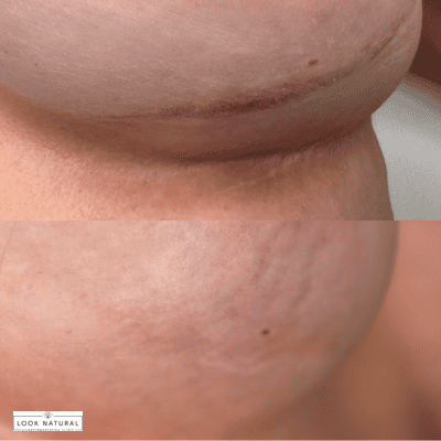 Close-up of a healed chin scar with faint purple stretch marks along the jawline.
