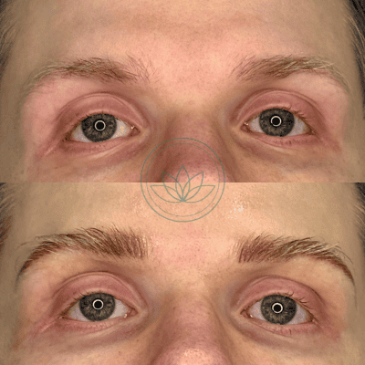 Before-and-after close-ups of a person's eyes: top image shows redness and irritation around the eyelids, bottom image shows reduced redness and improved eyelid appearance after treatment.