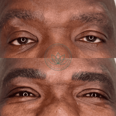Close-up, before-and-after shots of a man's eyes and brows: top shows sparse eyebrows, bottom shows fuller, well-defined brows after treatment.