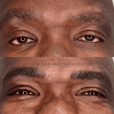 Before-and-after close-up of a person’s eyes showing brow/eyelid improvement from a cosmetic treatment; a centered logo and the text 'LOOK NATURAL ATLANTA' appear across the middle.