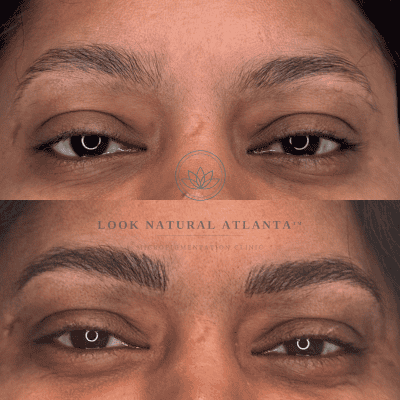 Close-up of eyes showing before (top) and after (bottom) results from a cosmetic eyelid/brow treatment at Look Natural Atlanta; brows look fuller and eyelids appear more open.