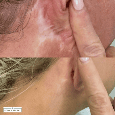Two close-up side-by-side views of the area behind the ear showing a scar: the top image shows a raised pink scar, the bottom image shows a lighter, flatter scar after treatment.