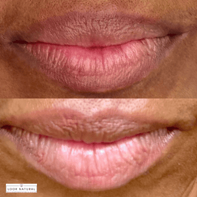 Close-up of dark lips shown in two images (top and bottom) highlighting dry, chapped texture.