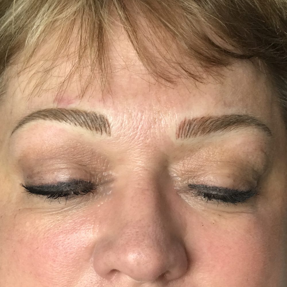 Natural-looking eyebrows recreated with nano needle paramedical tattooing after alopecia