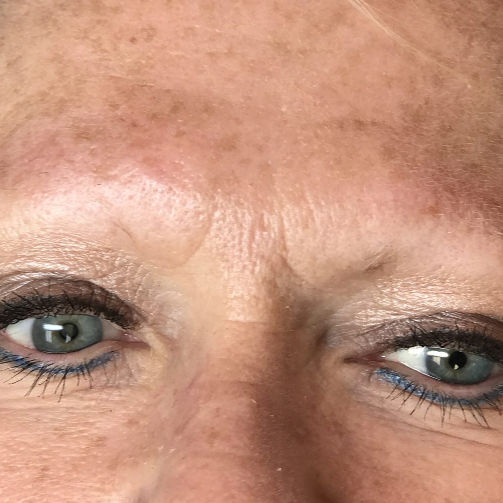 Complete eyebrow loss from alopecia before medical brow restoration