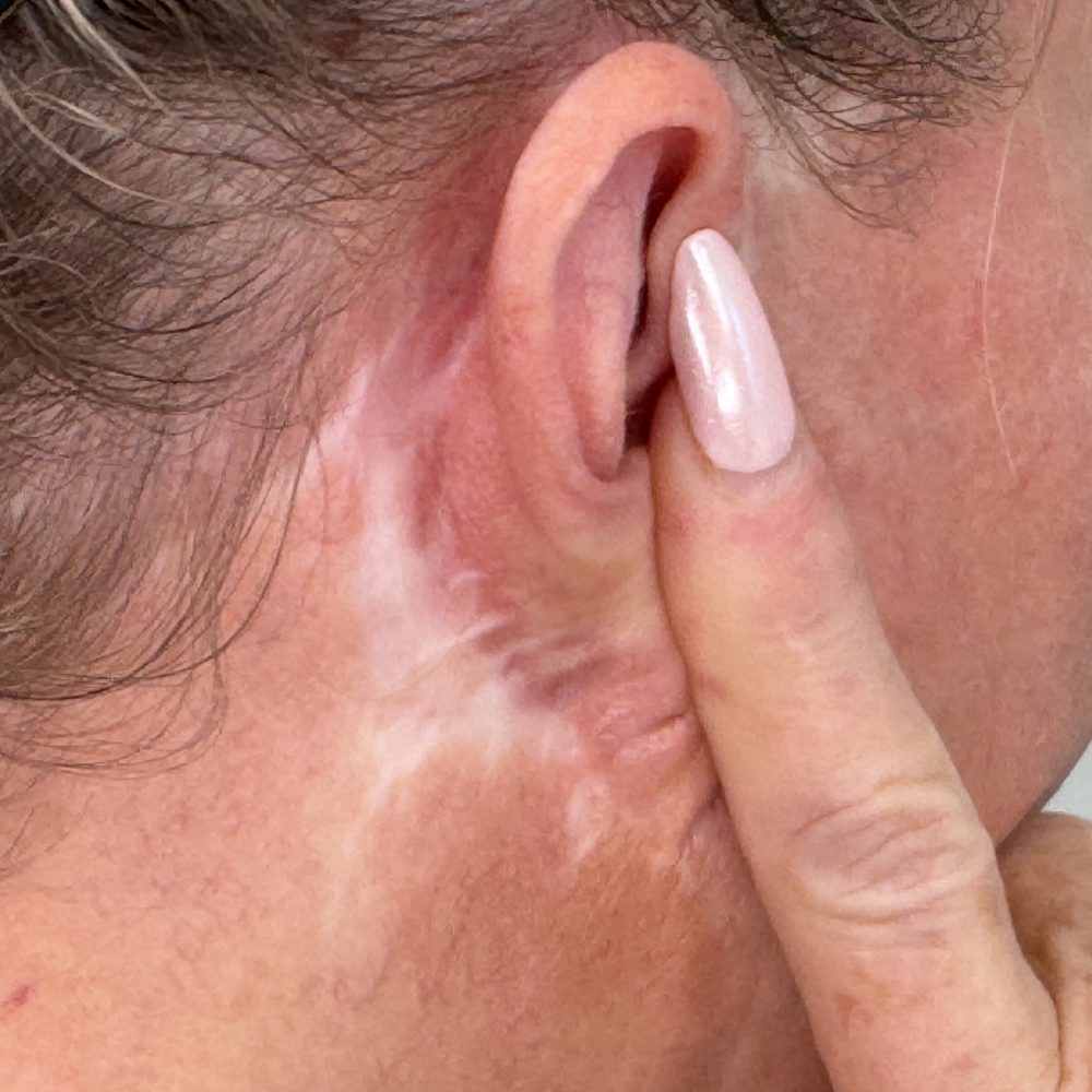 Visible facelift scar behind ear before paramedical scar camouflage treatment