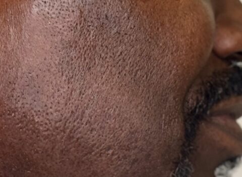 Close-up of a man’s cheek and jawline showing textured skin and stubble beard.