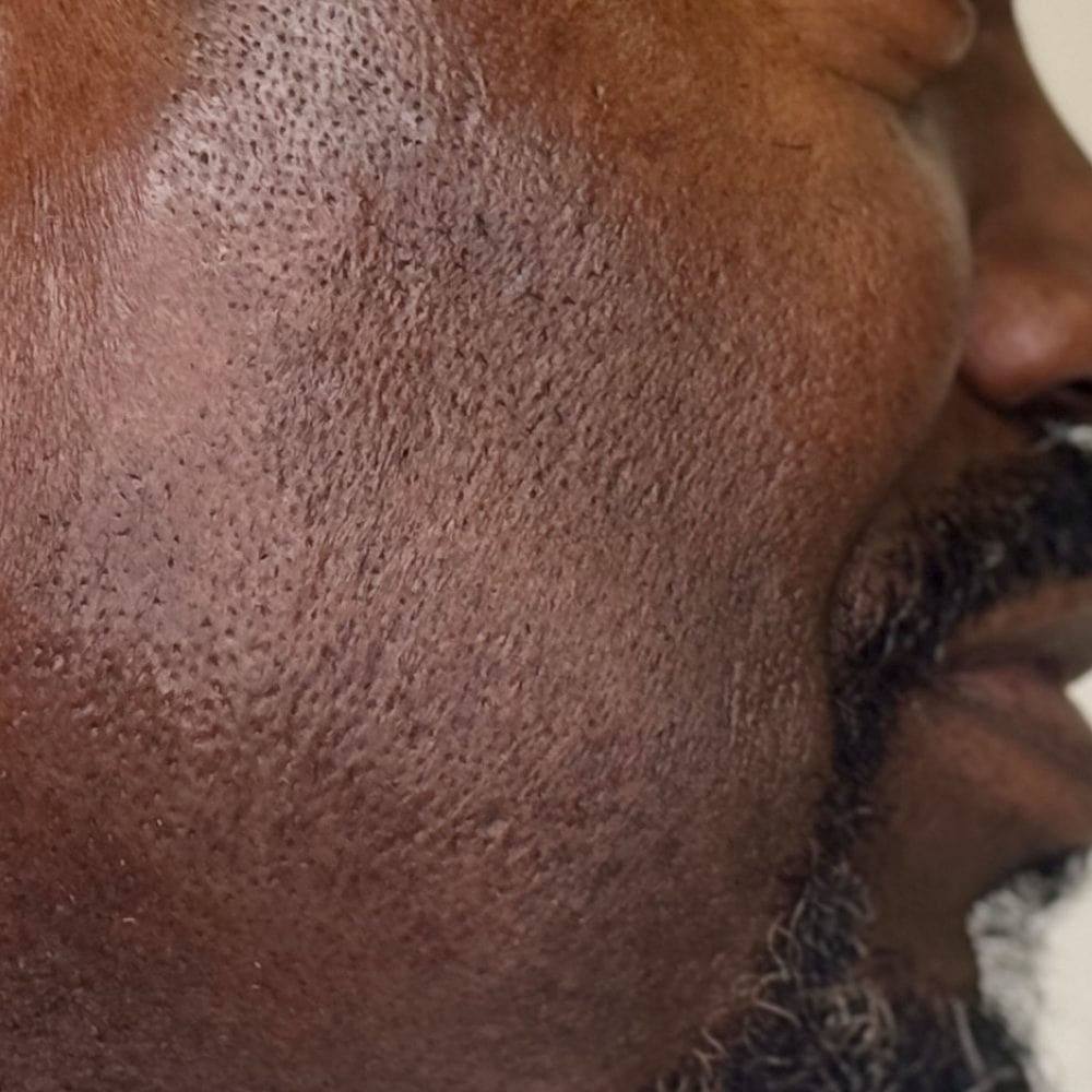 Close-up of a man’s cheek and jawline showing textured skin and stubble beard.