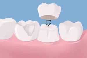 dental-crowns