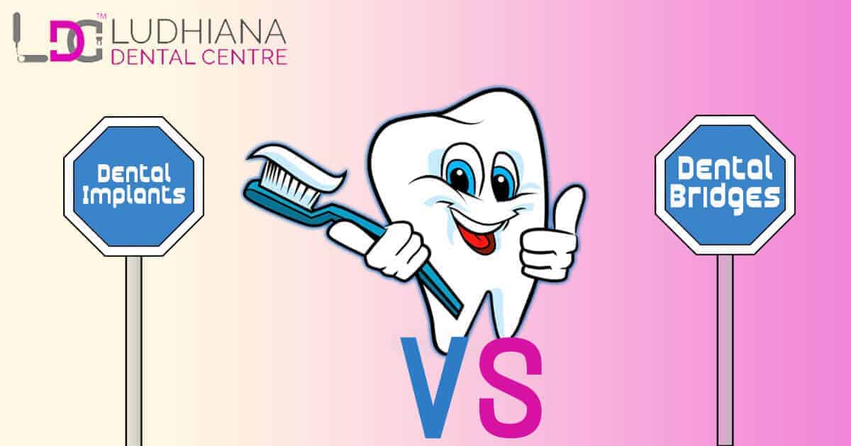 Dental implants vs dental bridges at Ludhiana Dental Centre for effective tooth restoration solutions.