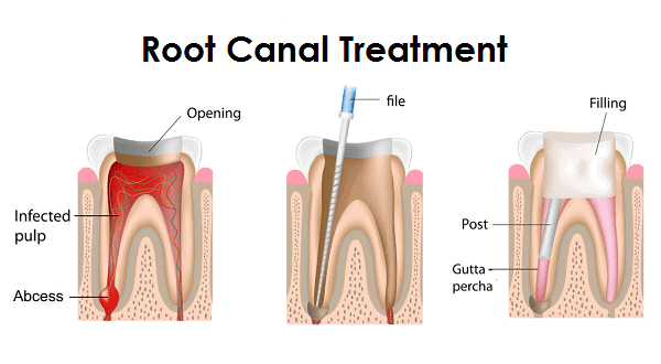 Root canal treatment procedure explaining infection removal and tooth sealing at Ludhiana Dental Centre.