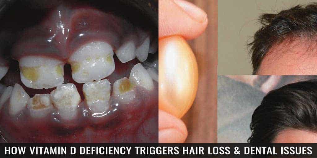 White decayed toddler teeth dental decay in children.