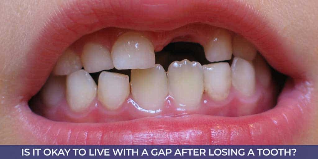 Missing tooth and dental gap in child's mouth due to tooth loss.